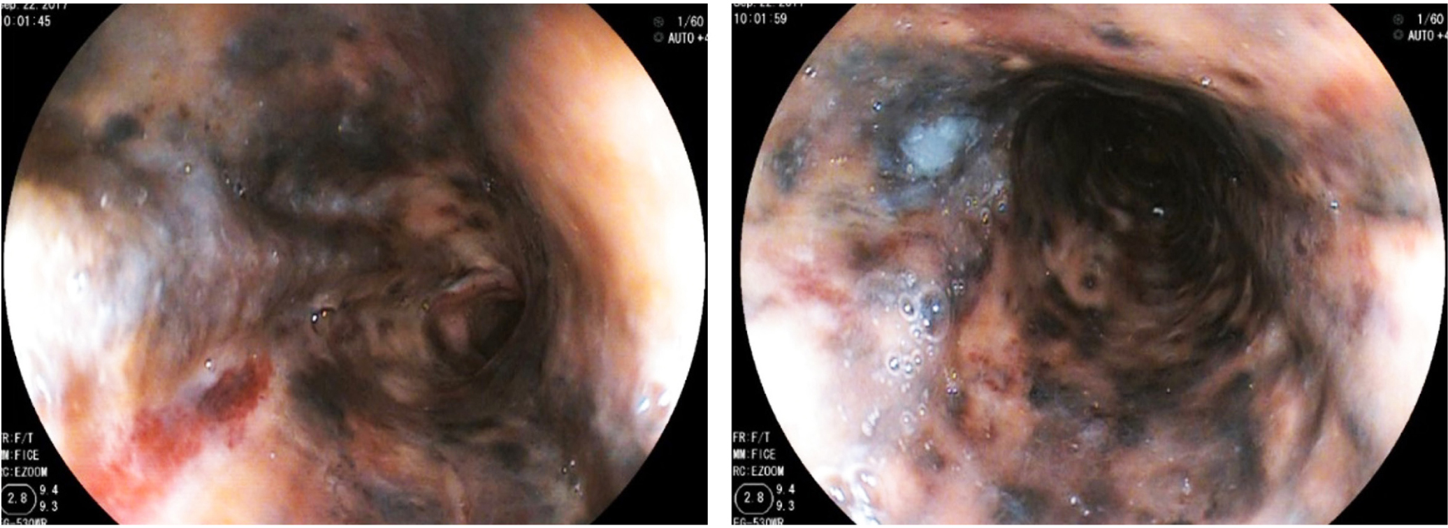 Figura 1. Necrosis esofágica aguda (NEA).