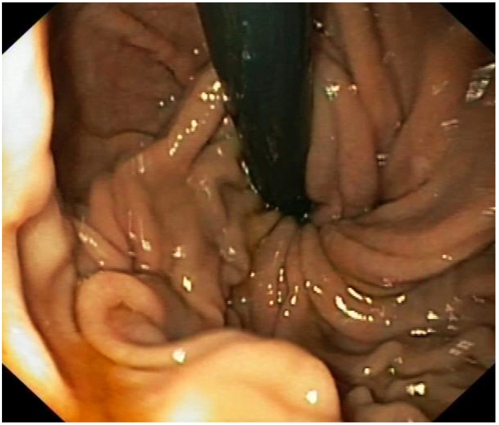 Figura 1. Imagen endoscópica en retroversión de la fundoplicatura durante el ingreso.