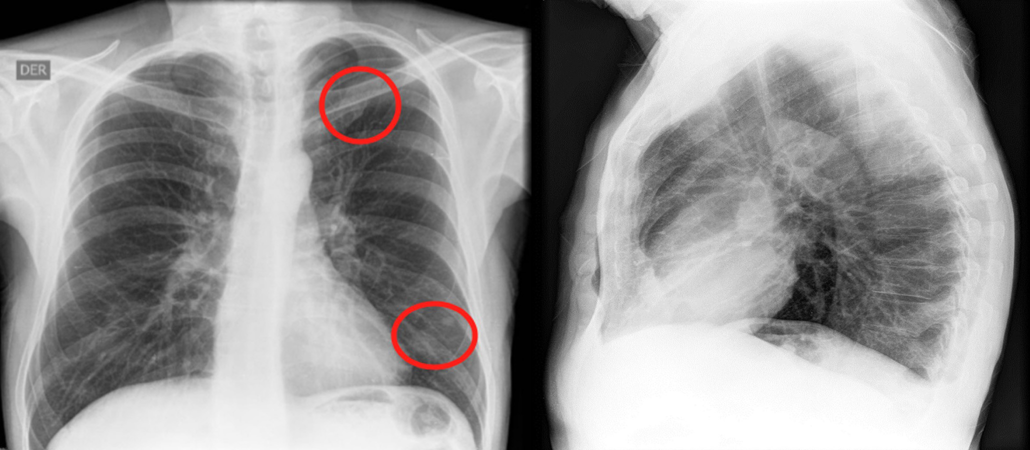 Figura 1. En la radiografía de tórax se observan opacidades nodulares con densidad de tejidos blandos, proyectadas a nivel de los lóbulos superior e inferior izquierdo. Fuente: archivo de los autores.