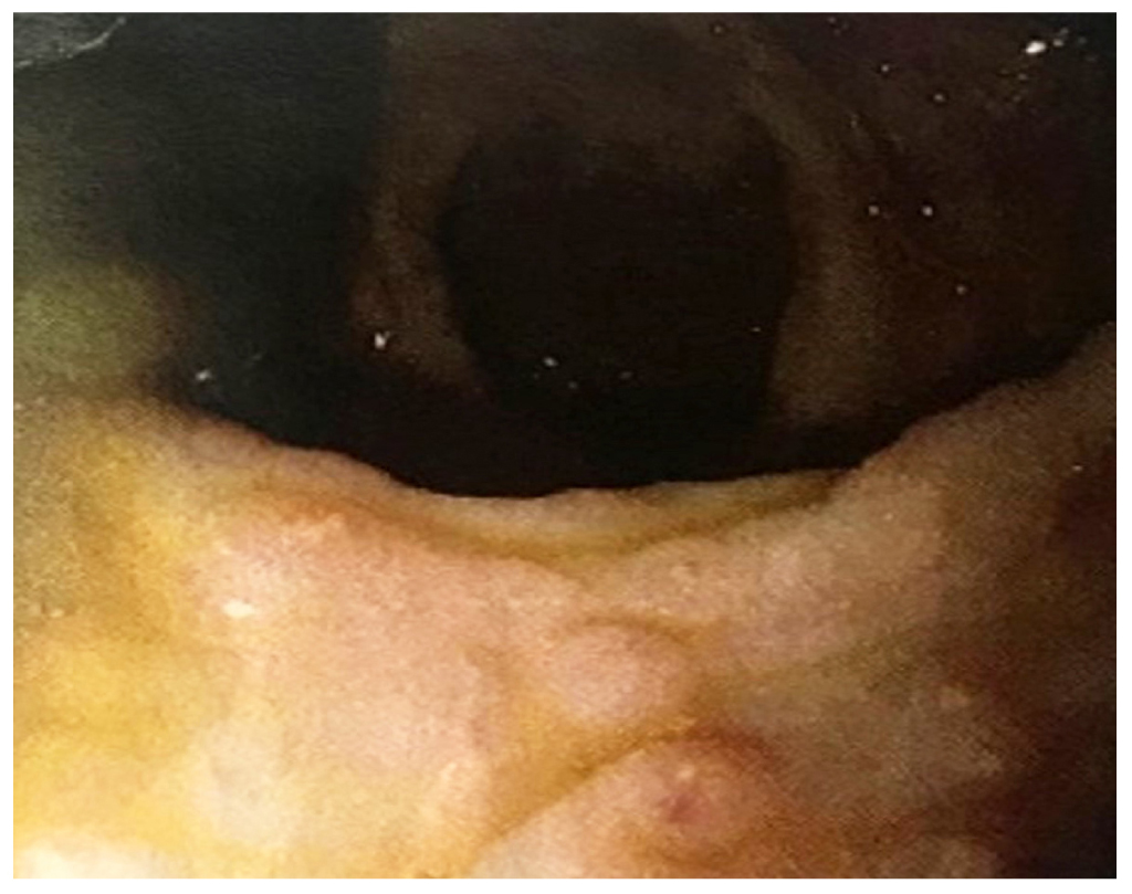 Figura 1. Videocolonoscopia en la que se observa la mucosa del colon sigmoide y recto con formaciones nodulares pseudopolipoidea