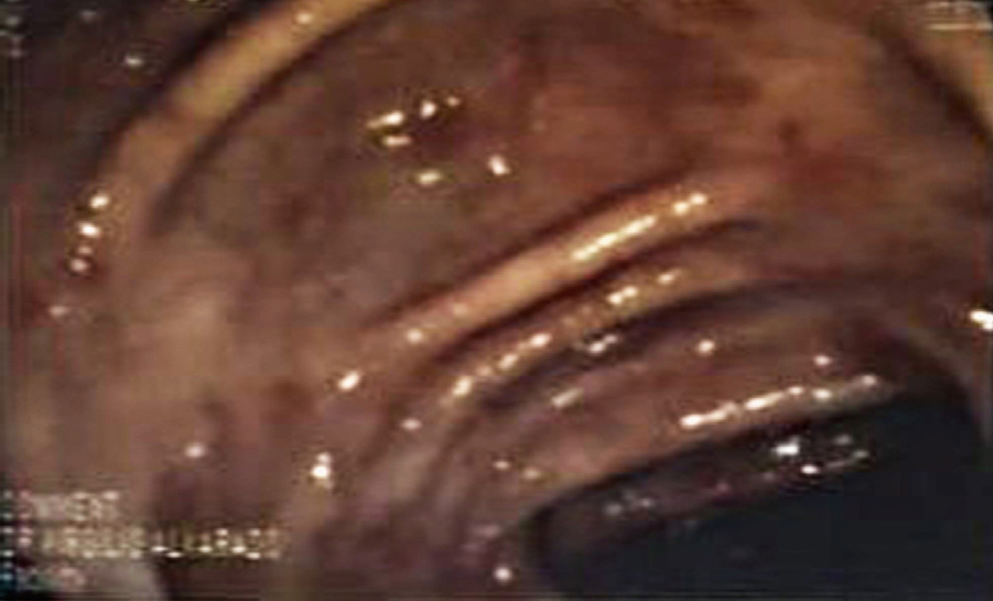 Figura 1. Colonoscopia: hemorragias subepiteliales y erosiones en el colon transverso