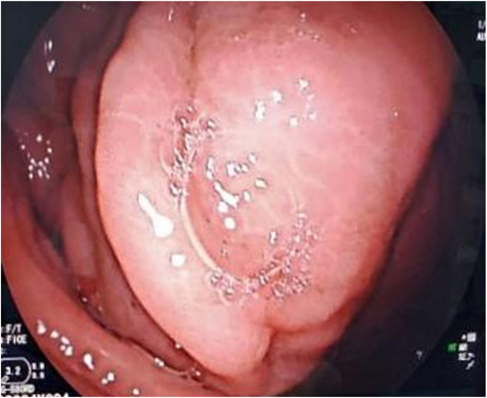 Figura 1. Videoendoscopia digestiva alta donde se observa una compresión extrínseca a nivel del cuerpo distal.