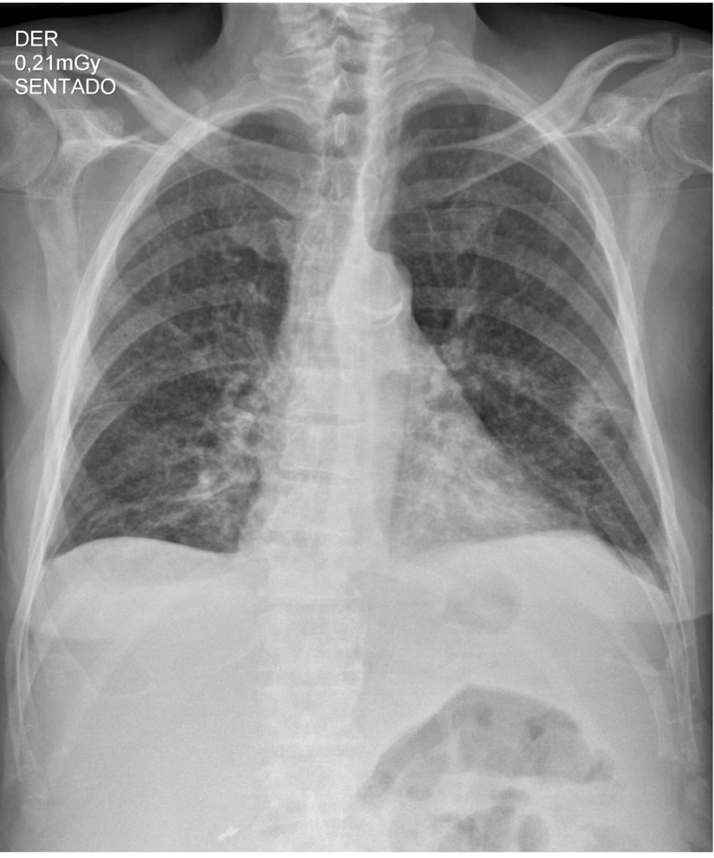 Figura 1. Radiografía anteroposterior (AP) de tórax que muestra opacidades intersticiales reticulares gruesas en ambos campos pulmonares y ángulos costofrénicos libres