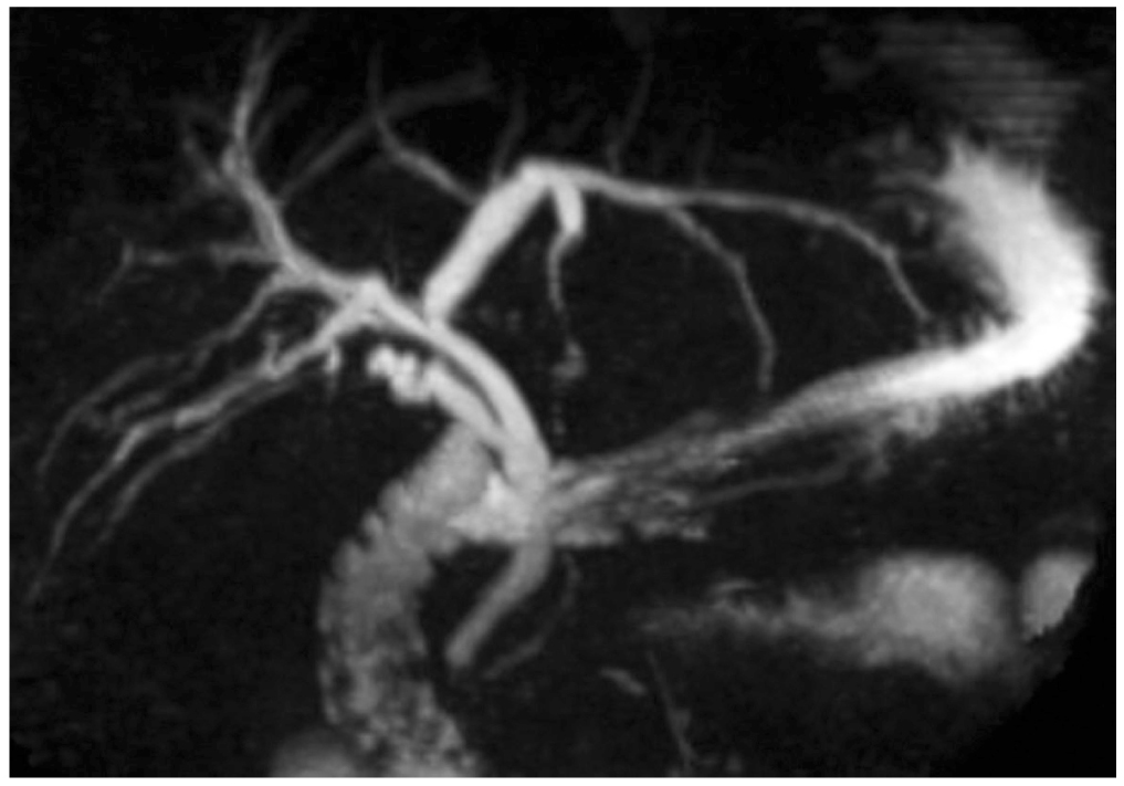 Figura 1. CPRNM. Estado poscolecistectomía, dilatación de la vía biliar intrahepática en el lóbulo izquierdo, colédoco de 8 mm