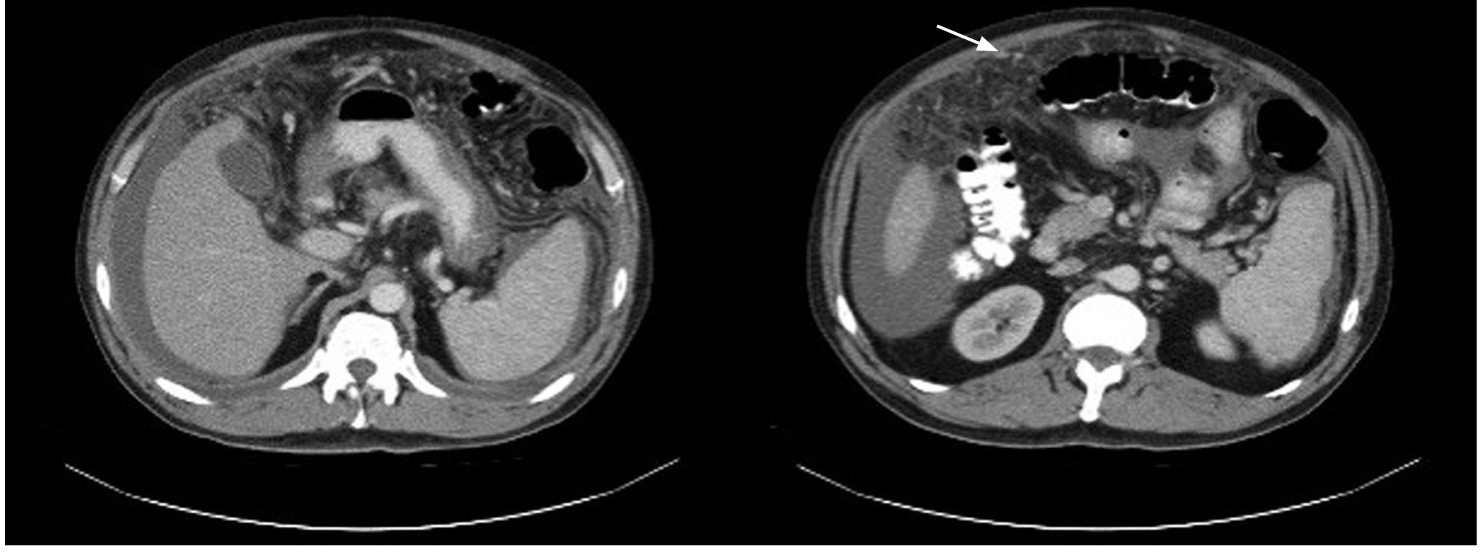 Figura 1. TAC de abdomen contrastada. Hígado pequeño, engrosamiento y múltiples nódulos pequeños en el peritoneo que realzan con el medio de contraste.
