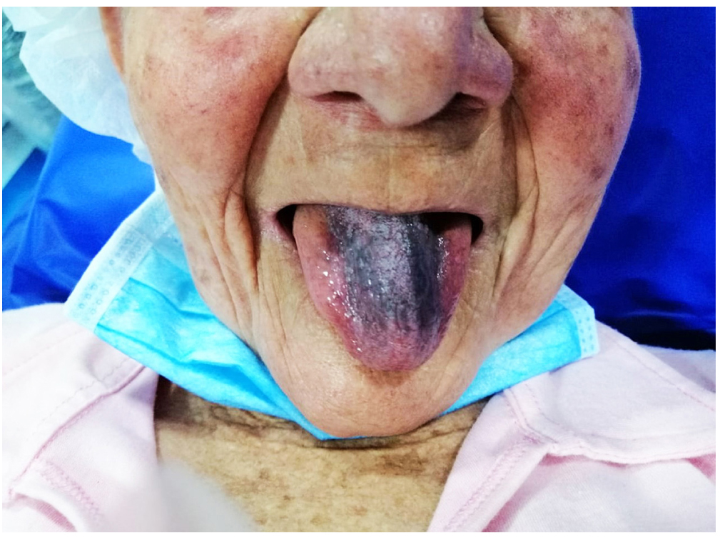Figura 1. Paciente con coloración negra del dorso de la lengua, que no compromete los bordes laterales ni la punta.