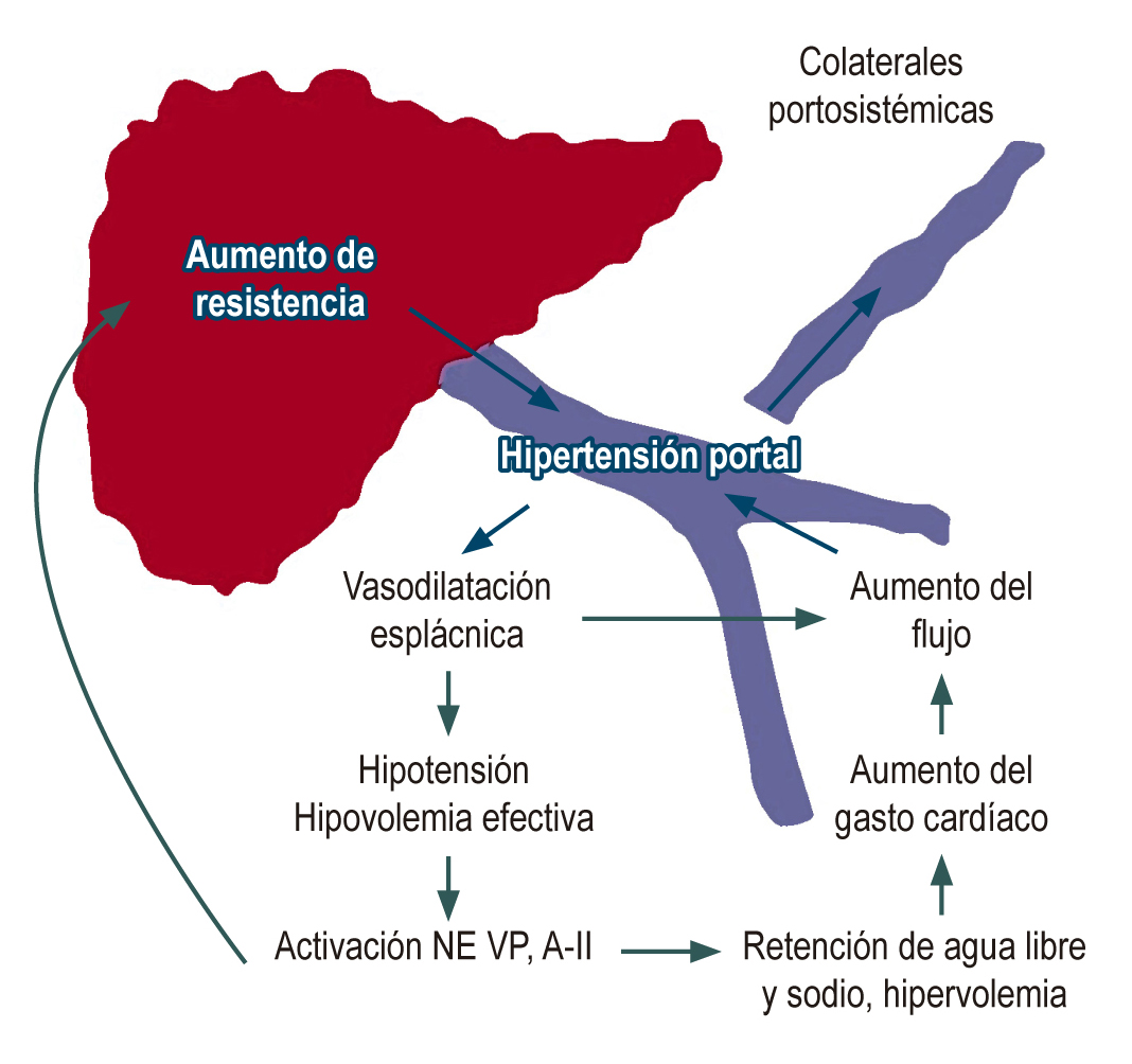 Figura 2. Fisiopatología de la hipertensión portal. AII: Angiotentesina; NE: Norepinefrina; VP: Vasopresina