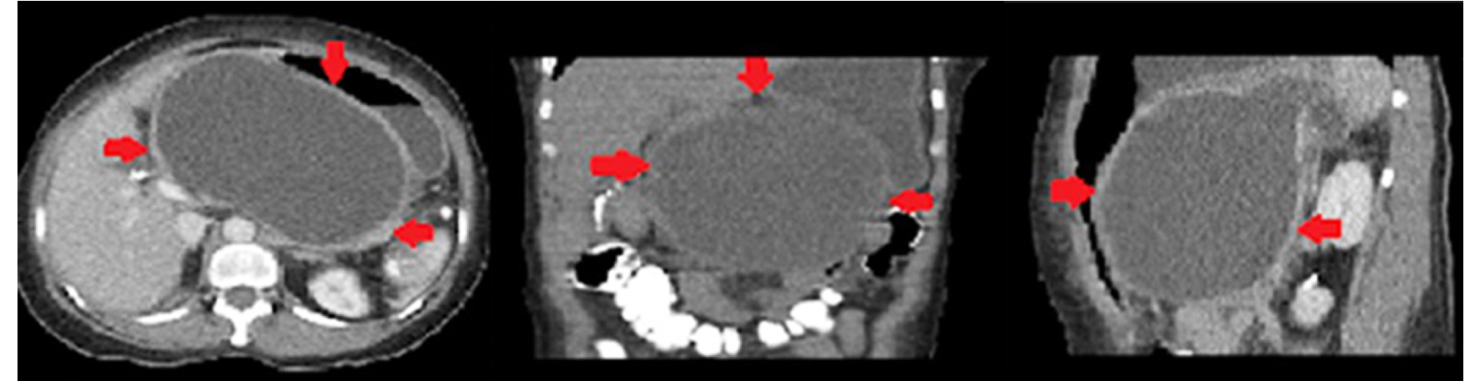 Figura 1. Tomografía computarizada de abdomen y pelvis