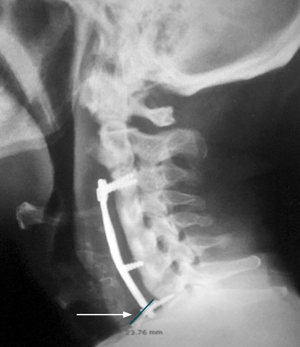 Figura 1. Radiografía lateral de columna cervical. Placa de artrodesis con fijación proximal en C3 y distal en C7 (flecha), tornillo intermedio y tornillo distal desplazado. Fuente: archivo de los autores.