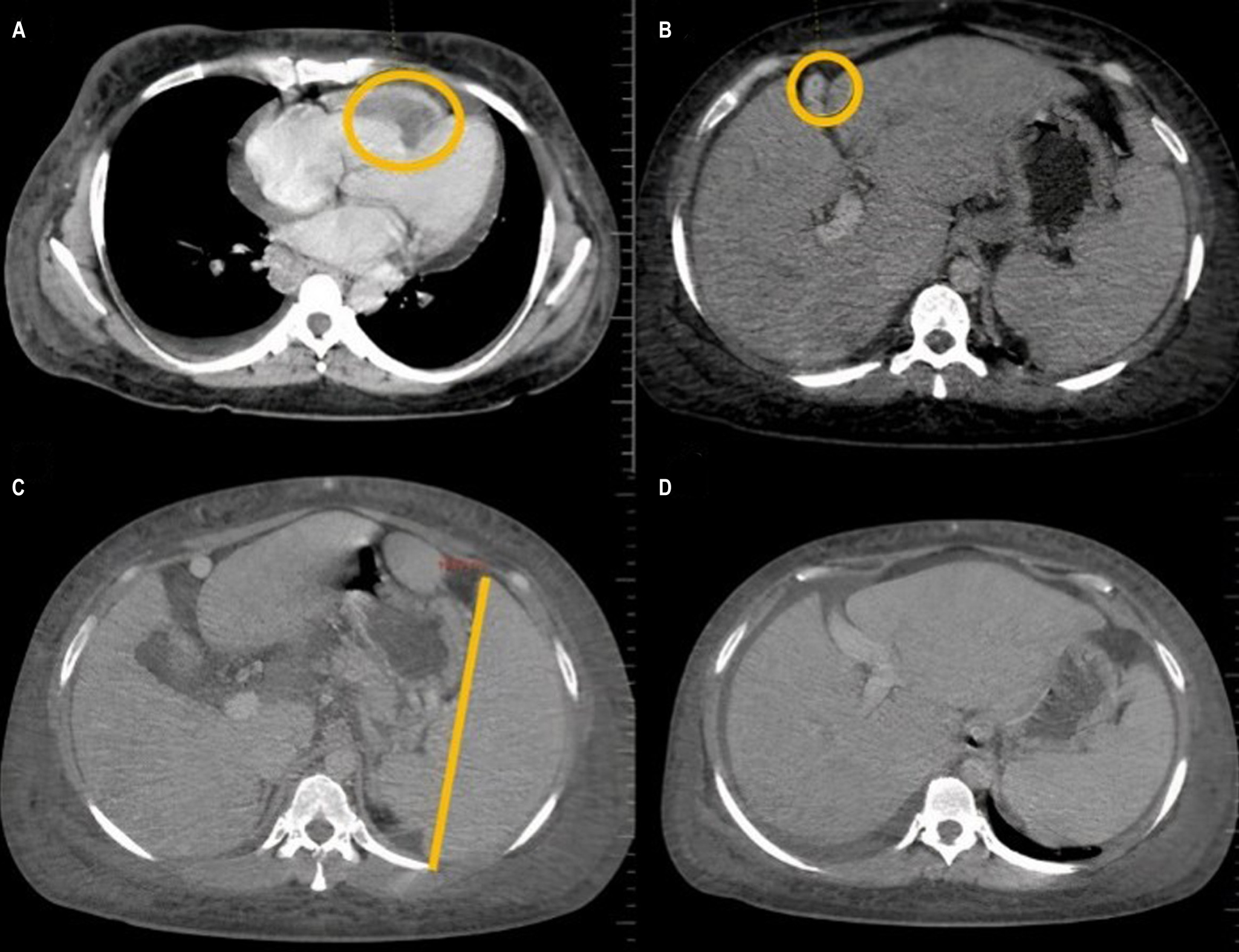 Figure 1. Contrasted CT revealing: A. Right atrial thrombosis; B. BCS detected by the absence of blood flow at the level of the outflow tract of the middle suprahepatic vein, hepatomegaly; C and D. Splenomegaly, ascites, and collateral circulation. Courtesy of the radiology department, Hospital Regional de la Orinoquia (HORO).