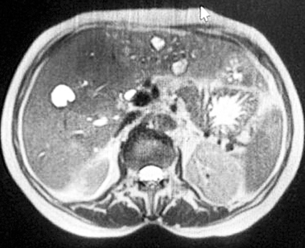 Figure 2. Magnetic resonance cholangiography showing dilation of the intrahepatic bile duct and a cystic lesion with regular borders. Source: Patient’s medical record.