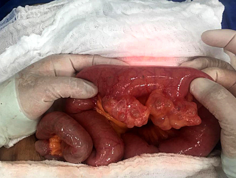 Figure 1. Intraoperative image showing diverticula in the jejunum. Source: Patient’s medical record.