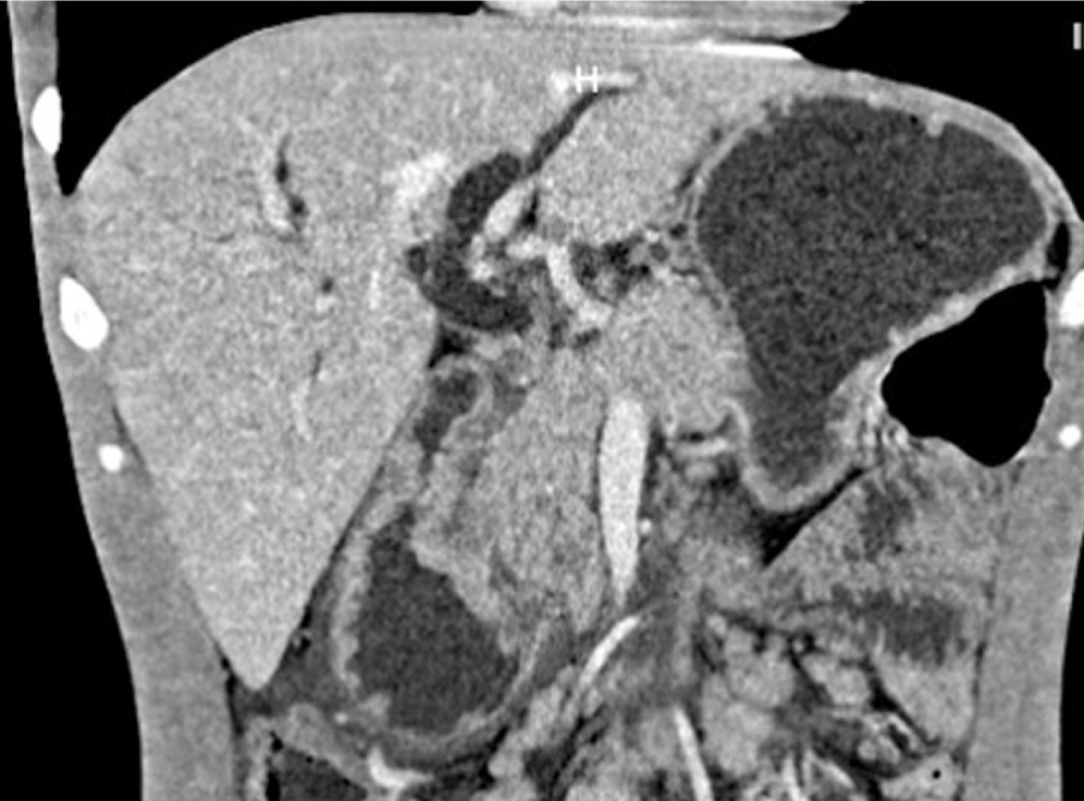 Figure 1. Simple and contrast-enhanced abdominal CT scan: dilation of the intra- and extrahepatic bile duct with a 14-millimeter common bile duct, the pancreas with slight dilation of the Wirsung duct, and loss of contours at the level of the head. 